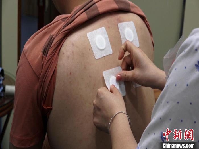 圖為醫(yī)生正在為民眾貼“三伏貼”。　唐蔚晴 攝
